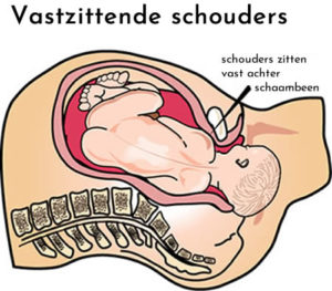 Vastzittende Schouders Baby, Wat Nu