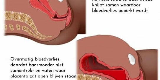 Bloedverlies Na Bevalling 2